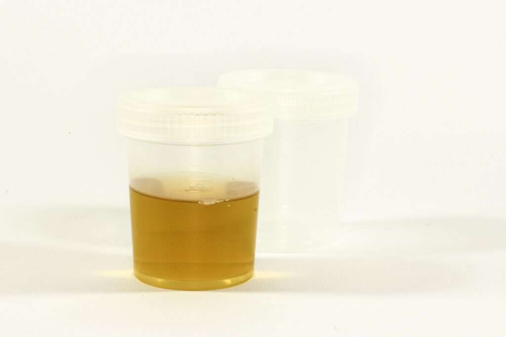 Physical Examination of Urine 