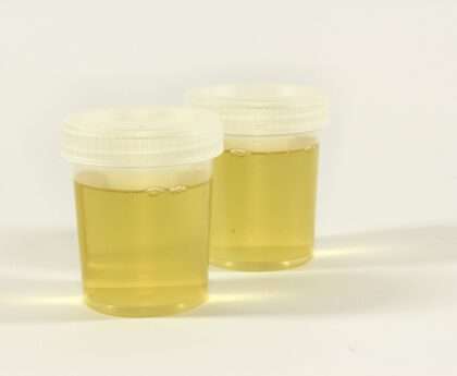 Physical Examination of Urine