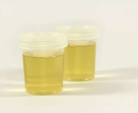 Physical Examination of Urine