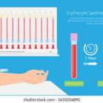 Erythrocyte Sedimentation Rate ( ESR ) Test