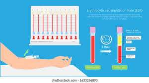 Erythrocyte Sedimentation Rate ( ESR ) Test