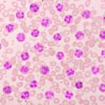 Absolute Eosinophil Count Test