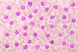 Absolute Eosinophil Count Test