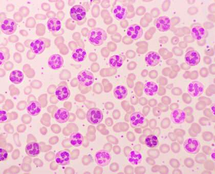 Absolute Eosinophil Count Test