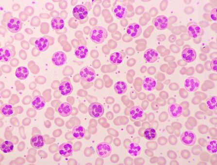 Absolute Eosinophil Count Test