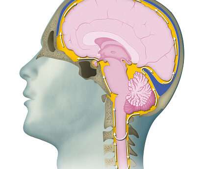 Cerebrospinal Fluid (CSF) Analysis