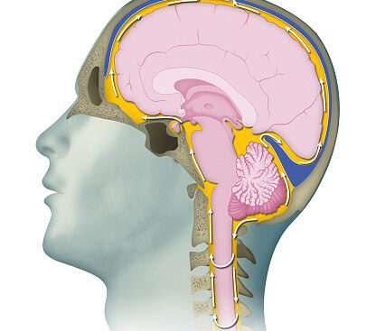 Cerebrospinal Fluid (CSF) Analysis